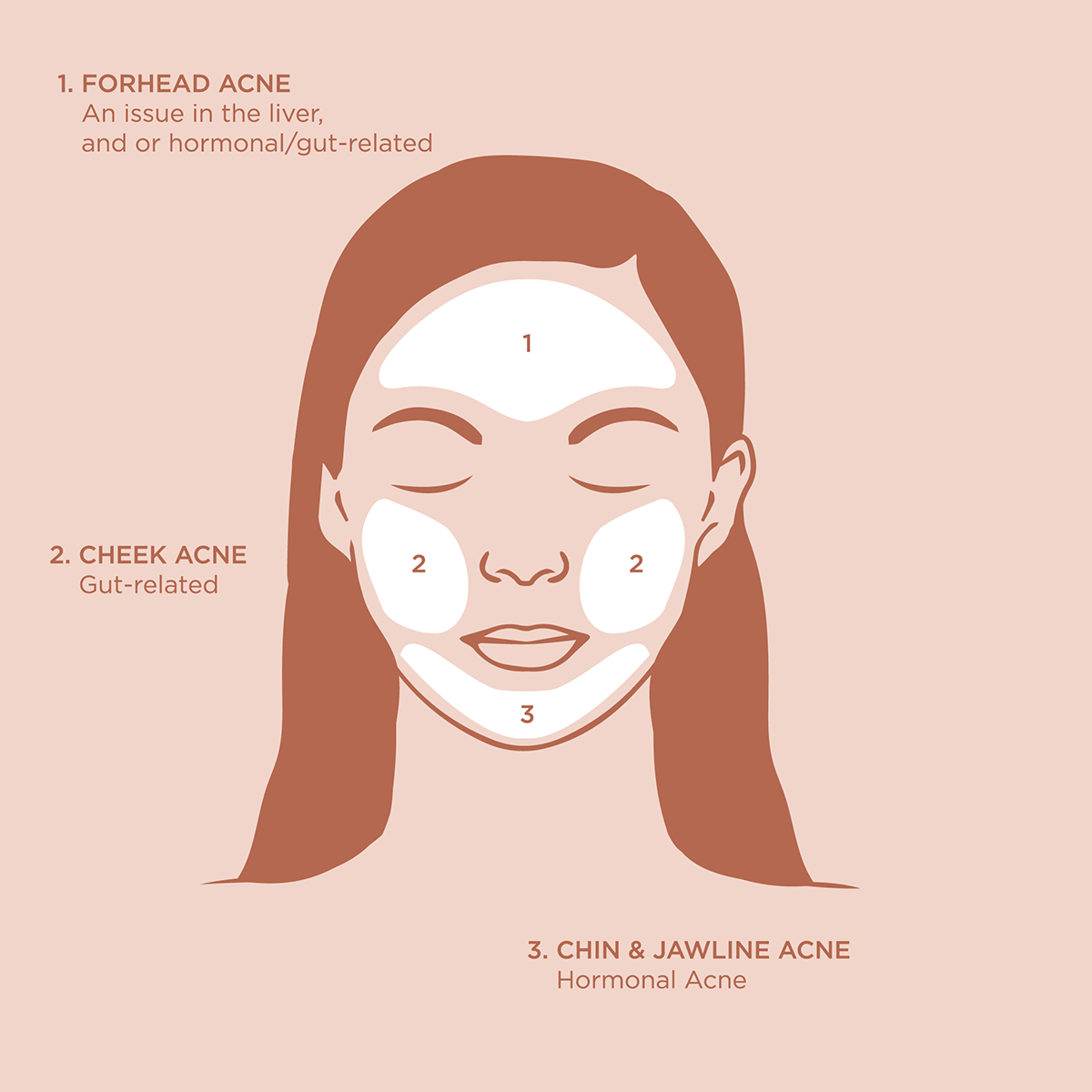 Diagram showing acne location and related causes