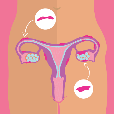 How Endometriosis Affects Daily Life (And What You Can Do About It)