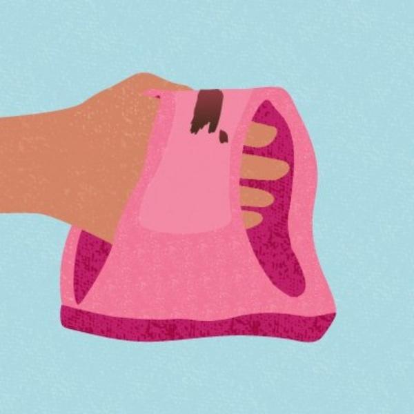 Spotting and Bleeding with a Contraceptive Implant: Causes and Solutions