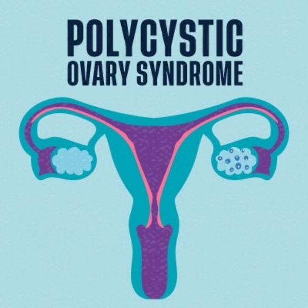 Can You Develop PCOS? Understanding the Causes & Risk Factors